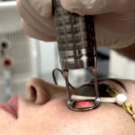 لیزر اربیوم چیست؟ جوانسازی دقیق پوست با کمترین ریسک و بیشترین تأثیر