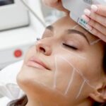 هایفو چیست و چرا به آن روش لیفت بدون جراحی میگویند؟